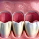 Gingivitis Causes Treatment 038 Prevention - Canadian health information