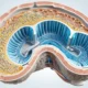 Protein in Urine Causes Symptoms 038 Treatment - Canadian health information